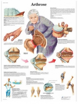 Lehrtafel - Arthrose