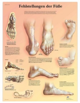 Lehrtafel - Fehlstellungen der Füße
