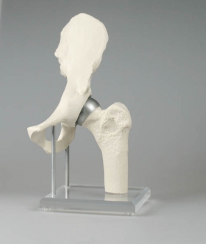 Hüftgelenk mit Schalenprothese