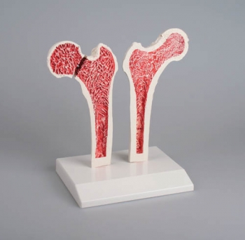 Osteoporose-Oberschenkel