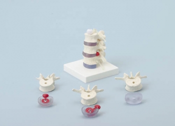 Lendenwirbel mit Bandscheibenvorfall