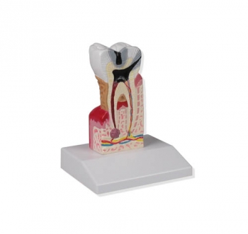 Zahnkariesmodell, 10-fache Größe