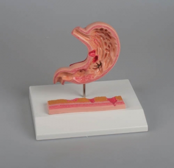 Magen mit Magengeschwüren