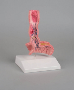 Erkrankungen der Speiseröhre