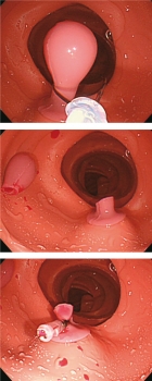 Optionale Erweiterung künstliche Polypen für die Polypektomie für LM107