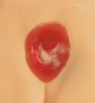 Druckgeschwür / Dekubitus Modelle