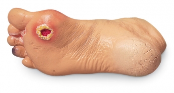 Erweiterte Fußprobleme