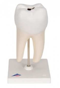 Unterer zweiwurzeliger Molar mit Karies, 2-teilig