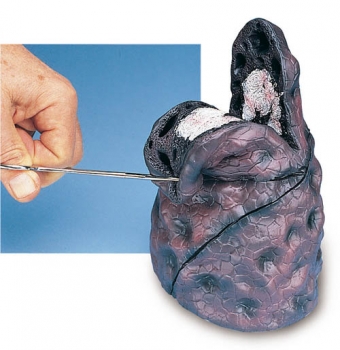 Lungenkrebs - Modell