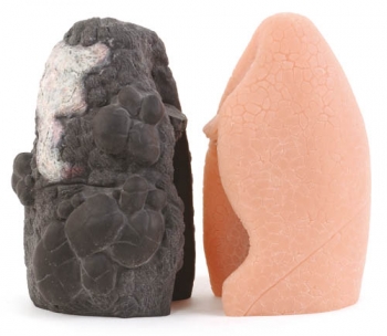 Lungenkrebs - Vergleichsmodell