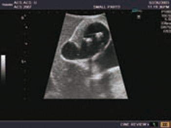 Ultraschall-Modell für Sonografie