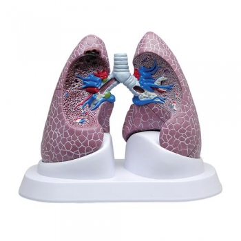 Lungen-Set mit Pathologien