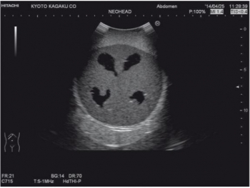 Neonatales Ultraschall-Übungsphantom Kopf mit Hydrocephalus