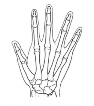 Rheumatisches Fingerphantom