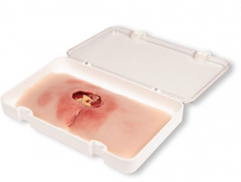 Wundmoulage sakraler Dekubitus, gesäubert