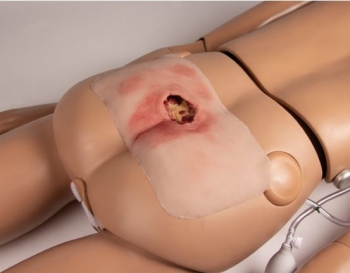 Wundmoulage sakraler Dekubitus, gesäubert