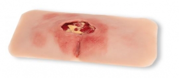 Wundmoulage sakraler Dekubitus, gesäubert