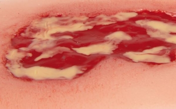 Wundmoulage Ulcus Cruris Venosum, klein, Exsudationsphase