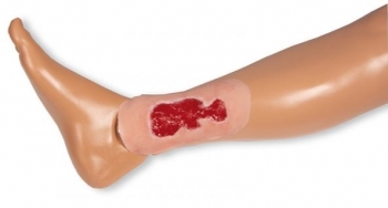 Wundmoulage Ulcus Cruris Venosum, klein, Granulationsphase