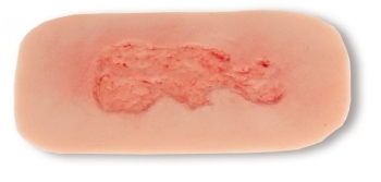 Wundmoulage Ulcus Cruris Venosum, klein, Epithelisierungsphase