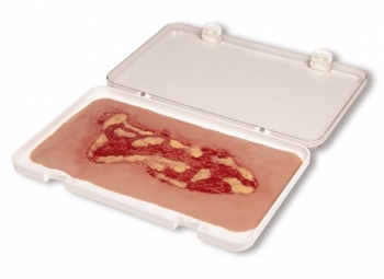 Wundmoulage Ulcus Cruris Venosum, groß, Exsudationsphase