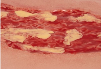 Wundmoulage Ulcus Cruris Venosum, groß, Exsudationsphase