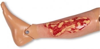 Wundmoulage Ulcus Cruris Venosum, groß, Exsudationsphase