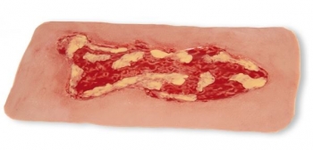 Wundmoulage Ulcus Cruris Venosum, groß, Exsudationsphase