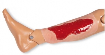 Wundmoulage Ulcus Cruris Venosum, groß, Granulationsphase