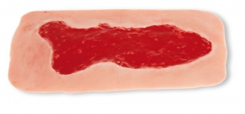 Wundmoulage Ulcus Cruris Venosum, groß, Granulationsphase