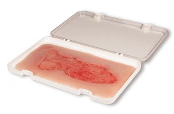 Wundmoulage Ulcus Cruris Venosum, groß, Epithelisierungsphase