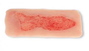 Wundmoulage Ulcus Cruris Venosum, groß, Epithelisierungsphase