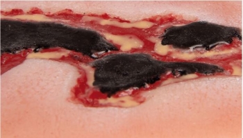 Wundmoulage Ulcus Cruris Arteriosum, klein, Exsudationsphase