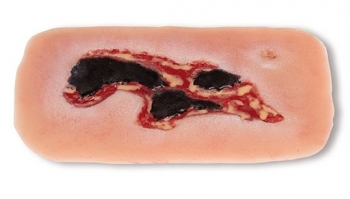 Wundmoulage Ulcus Cruris Arteriosum, klein, Exsudationsphase