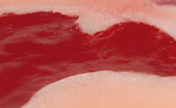 Wundmoulage Ulcus Cruris Arteriosum, klein, Granulationsphase