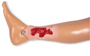 Wundmoulage Ulcus Cruris Arteriosum, klein, Granulationsphase