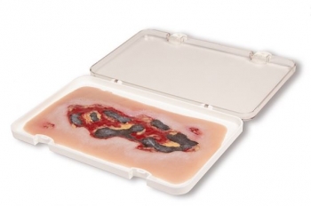 Wundmoulage Ulcus Cruris Arteriosum, groß, Exsudationsphase