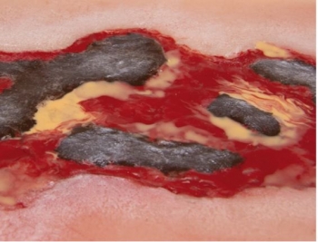 Wundmoulage Ulcus Cruris Arteriosum, groß, Exsudationsphase