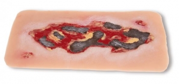 Wundmoulage Ulcus Cruris Arteriosum, groß, Exsudationsphase