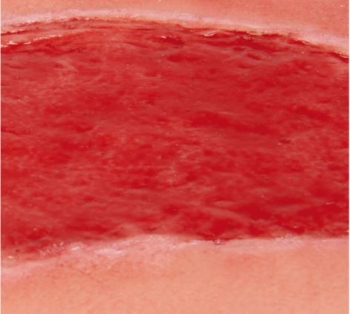 Wundmoulage Ulcus Cruris Arteriosum, groß, Granulationsphase