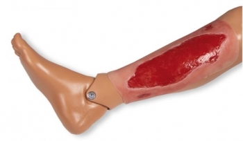 Wundmoulage Ulcus Cruris Arteriosum, groß, Granulationsphase