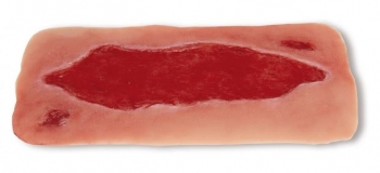 Wundmoulage Ulcus Cruris Arteriosum, groß, Granulationsphase