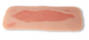 Wundmoulage Ulcus Cruris Arteriosum, groß, Epithelisierungsphase