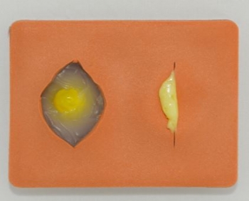 Simuliertes Gewebe mit Zyste und Abszess, helle Haut