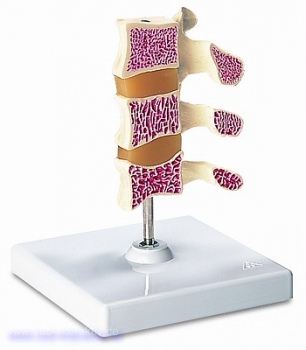 Osteoporose-Luxusmodell (3 Wirbel)