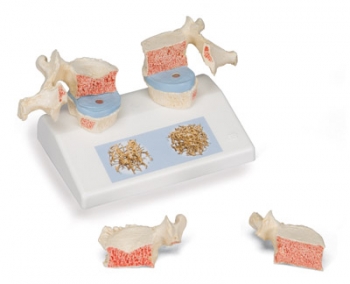 Osteoporose Modell