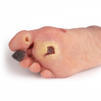 Wundenfuß mit diabetischem Fußsyndrom