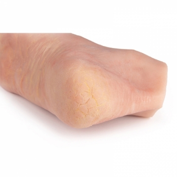 Wundenfuß mit diabetischem Fußsyndrom