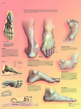 Lehrtafel - Fehlstellungen der Füße