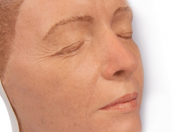 Kopf für Gesichtsinjektionen, Ausführung A